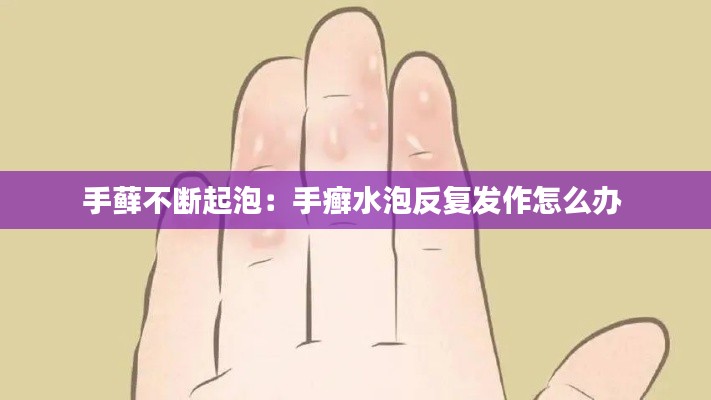 手藓不断起泡：手癣水泡反复发作怎么办 