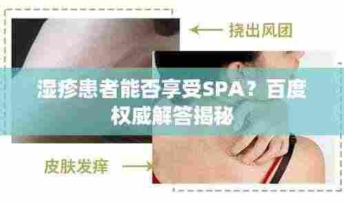 湿疹患者能否享受SPA?百度权威解答揭秘